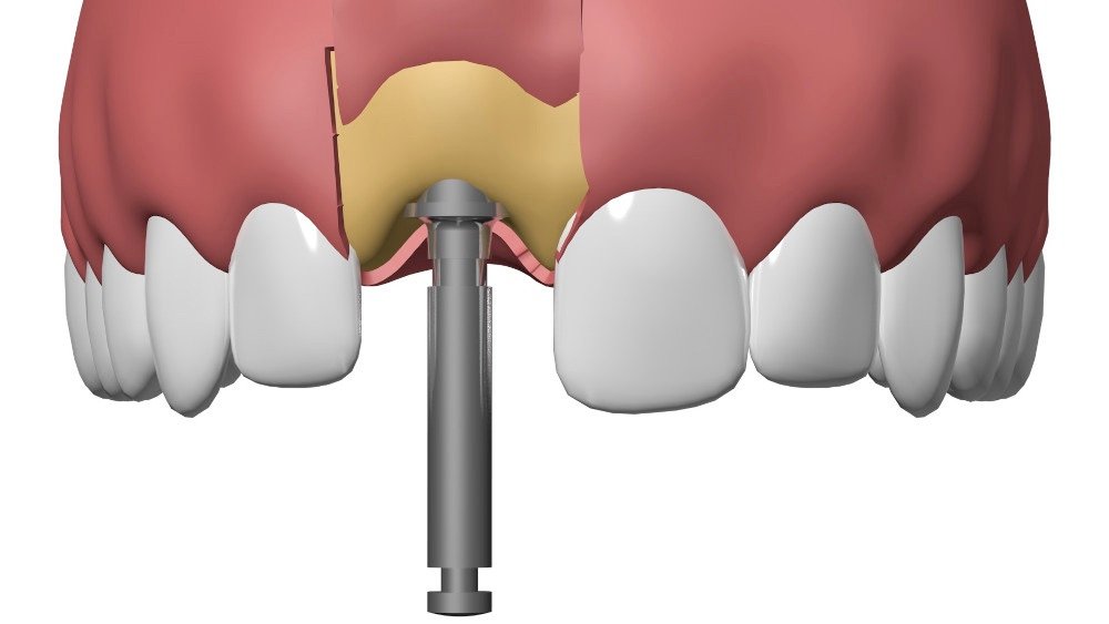 Implant dentaire Nimes Nicolas Henner